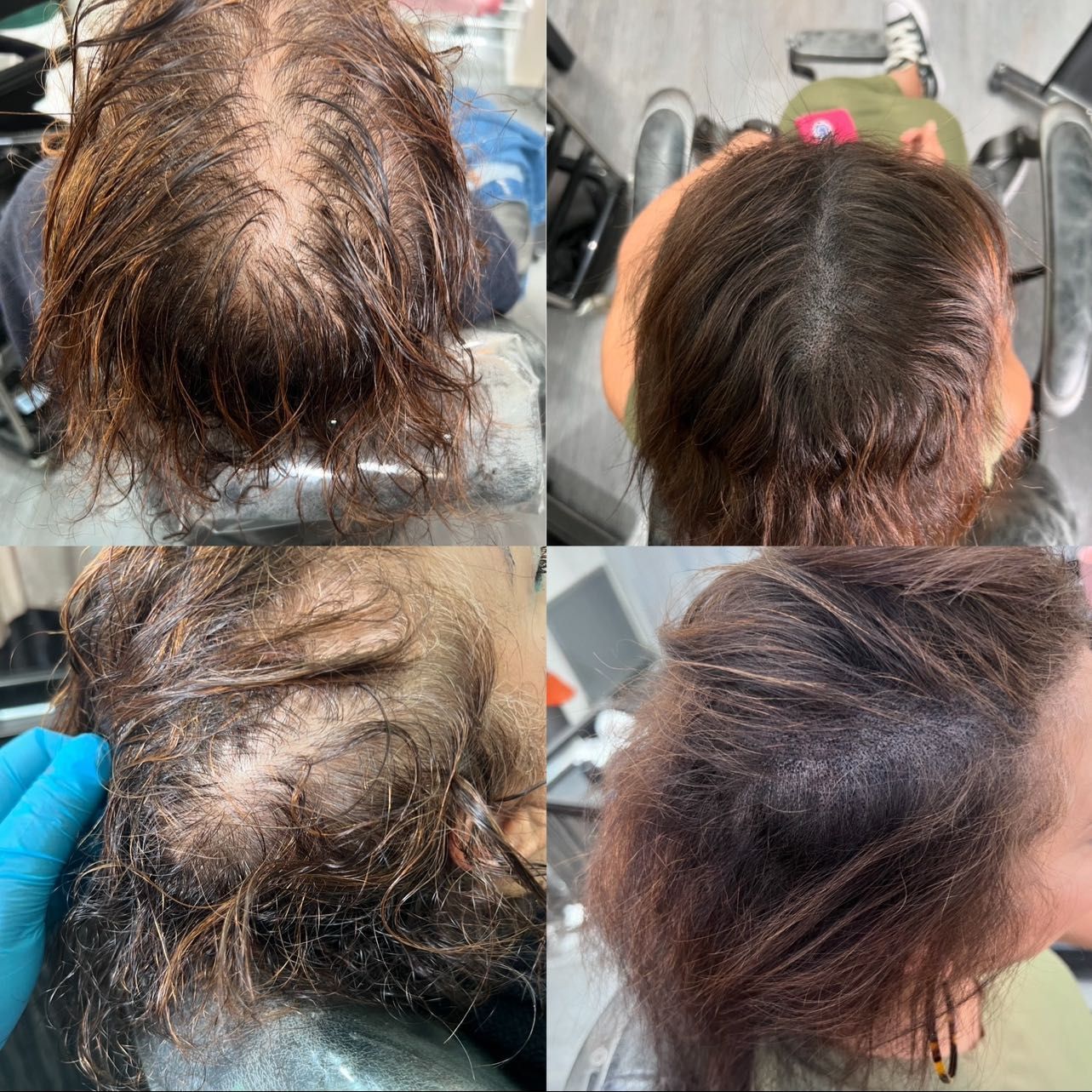 SMP - density for thinning hair