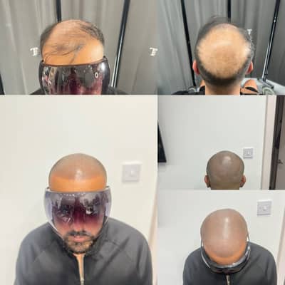 SMP - full head